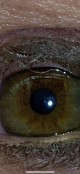 My eye, glassy unusual hair-like objects, eye pain