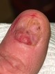 Nails from Morgellons