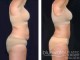 Tummy Tuck Surgery