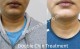 Double Chin treatment Delhi